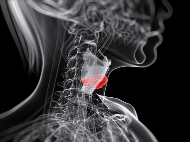 tumore della tiroide